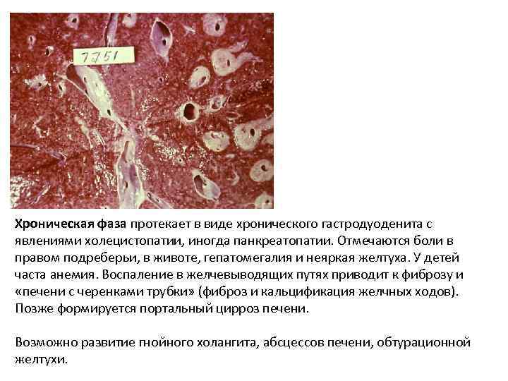 Хроническая фаза протекает в виде хронического гастродуоденита с явлениями холецистопатии, иногда панкреатопатии. Отмечаются боли