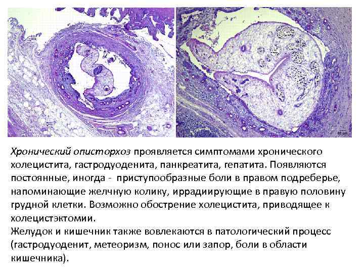Хронический описторхоз проявляется симптомами хронического холецистита, гастродуоденита, панкреатита, гепатита. Появляются постоянные, иногда - приступообразные