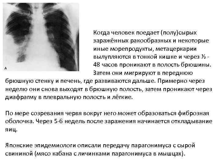Когда человек поедает (полу)сырых заражённых ракообразных и некоторые иные морепродукты, метацеркарии вылупляются в тонкой