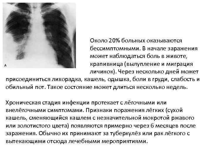 Около 20% больных оказываются бессимптомными. В начале заражения может наблюдаться боль в животе, понос