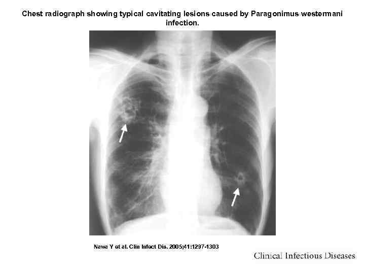 Chest radiograph showing typical cavitating lesions caused by Paragonimus westermani infection. Nawa Y et