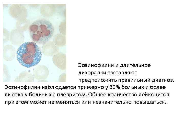Эозинофилия и длительное отсутствие лихорадки заставляют предположить правильный диагноз. Эозинофилия наблюдается примерно у 30%