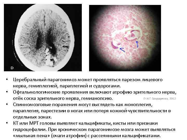  • Церебральный парагонимоз может проявляться парезом лицевого нерва, гемиплегией, параплегией и судорогами. •