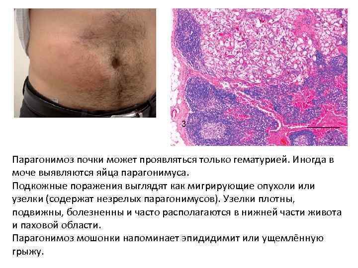 Парагонимоз почки может проявляться только гематурией. Иногда в моче выявляются яйца парагонимуса. Подкожные поражения