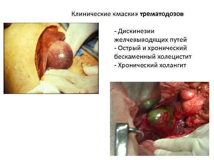 Клинические «маски» трематодозов - Дискинезии желчевыводящих путей - Острый и хронический бескаменный холецистит -