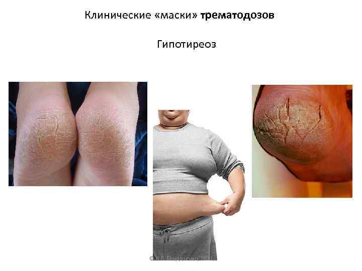 Клинические «маски» трематодозов Гипотиреоз © И. Г. Бондаренко, 2011 