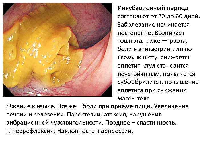 Инкубационный период составляет от 20 до 60 дней. Заболевание начинается постепенно. Возникает тошнота, реже