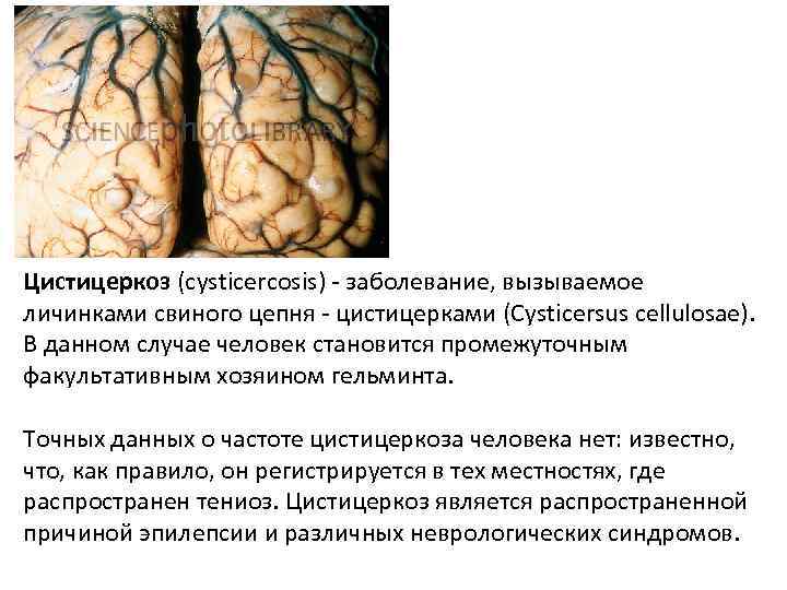 Цистицеркоз (cysticercosis) - заболевание, вызываемое личинками свиного цепня - цистицерками (Cysticersus cellulosae). В данном