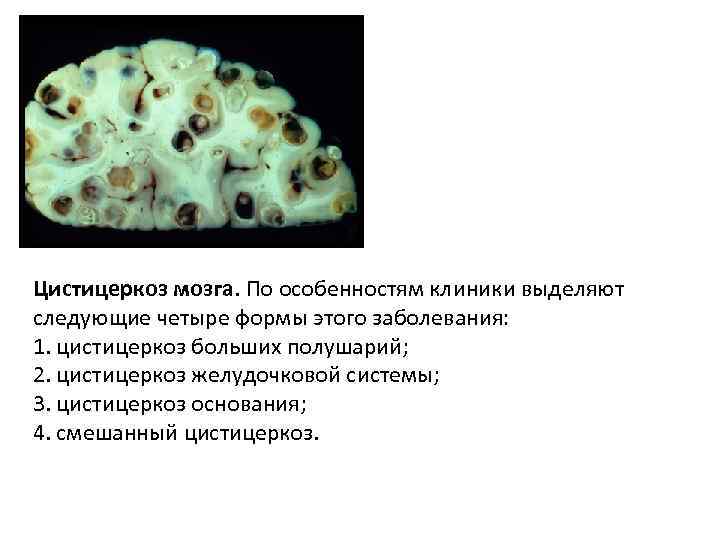 Цистицеркоз мозга. По особенностям клиники выделяют следующие четыре формы этого заболевания: 1. цистицеркоз больших