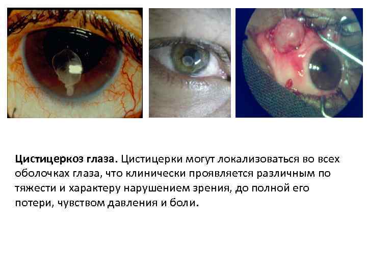 Цистицеркоз глаза. Цистицерки могут локализоваться во всех оболочках глаза, что клинически проявляется различным по