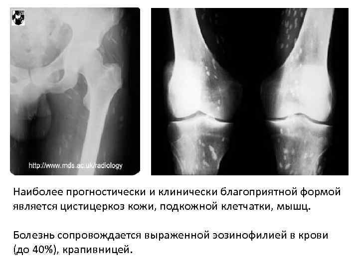 Наиболее прогностически и клинически благоприятной формой является цистицеркоз кожи, подкожной клетчатки, мышц. Болезнь сопровождается