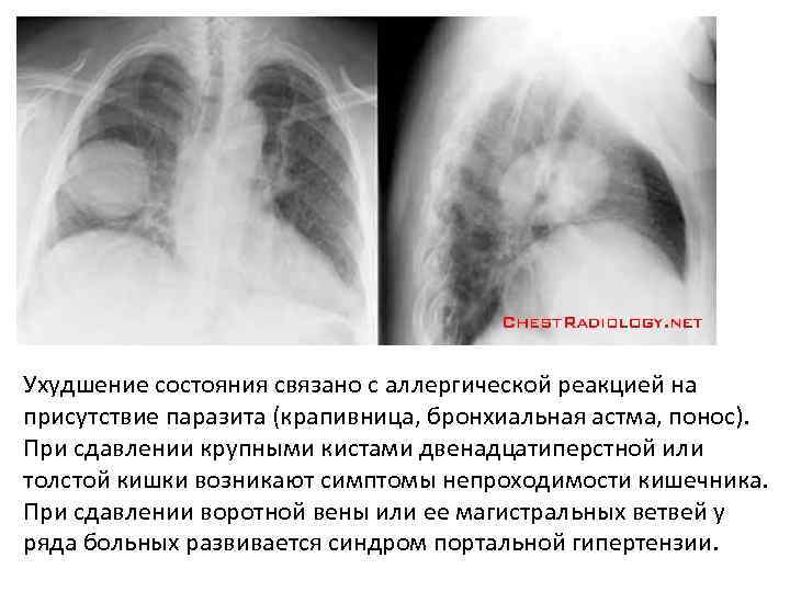 Ухудшение состояния связано с аллергической реакцией на присутствие паразита (крапивница, бронхиальная астма, понос). При