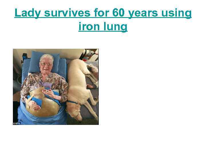 Lady survives for 60 years using iron lung 