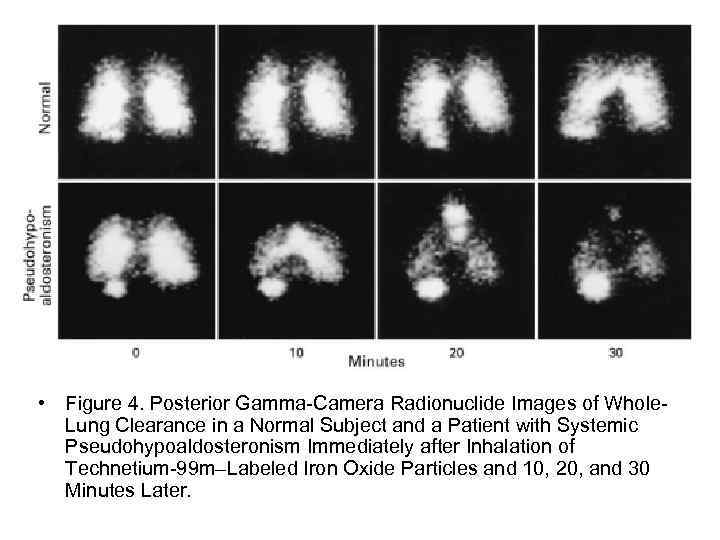  • Figure 4. Posterior Gamma-Camera Radionuclide Images of Whole. Lung Clearance in a