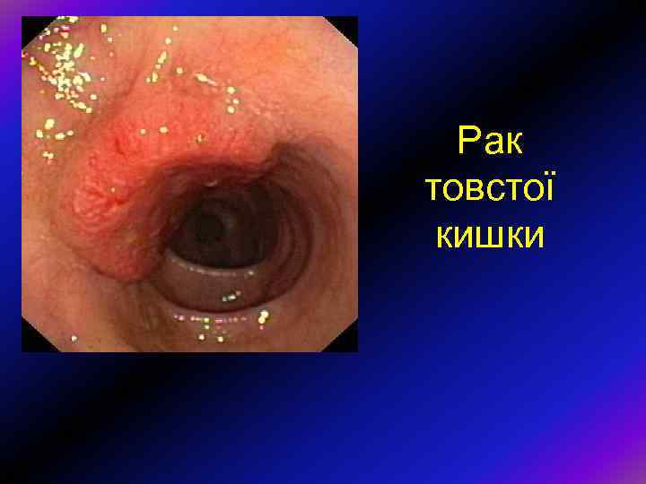 Рак товстої кишки 