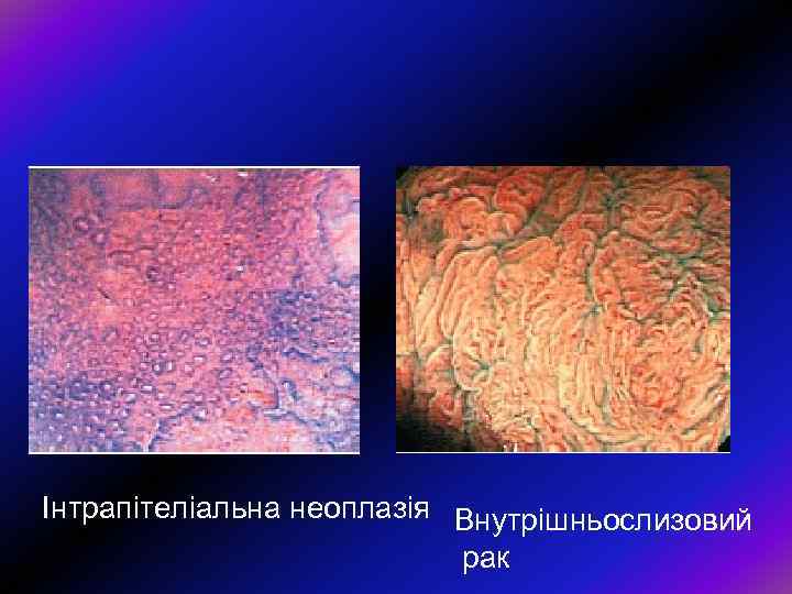 Інтрапітеліальна неоплазія Внутрішньослизовий рак 