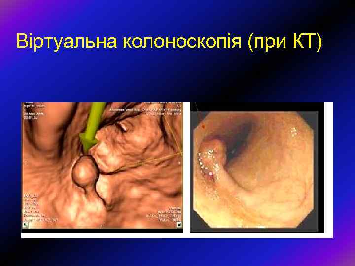 Віртуальна колоноскопія (при КТ) 