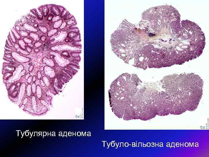 Тубулярна аденома Тубуло-вільозна аденома 