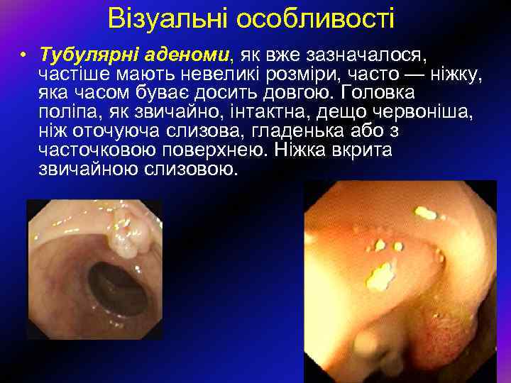 Візуальні особливості • Тубулярні аденоми, як вже зазначалося, частіше мають невеликі розміри, часто —