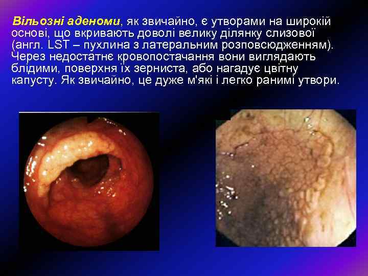 Вільозні аденоми, як звичайно, є утворами на широкій основі, що вкривають доволі велику ділянку