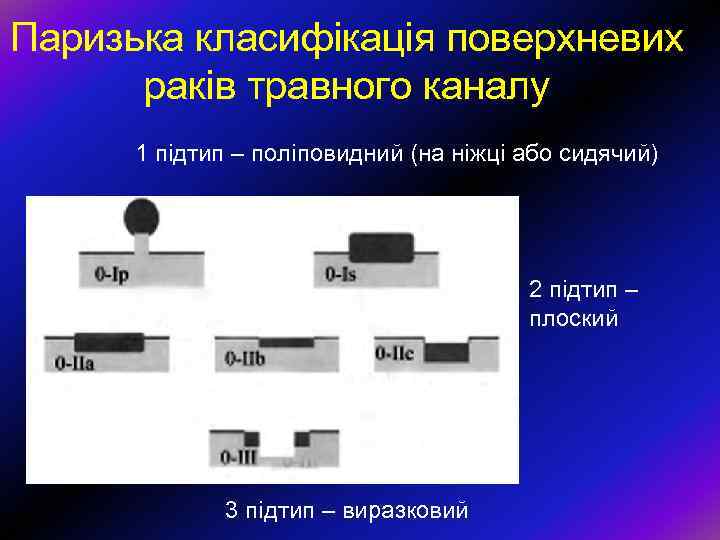 Паризька класифікація поверхневих раків травного каналу 1 підтип – поліповидний (на ніжці або сидячий)