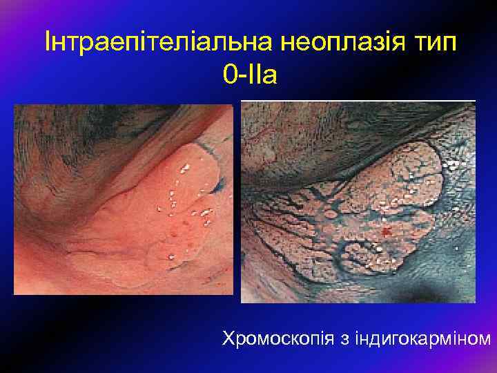 Інтраепітеліальна неоплазія тип 0 -ІІа Хромоскопія з індигокарміном 
