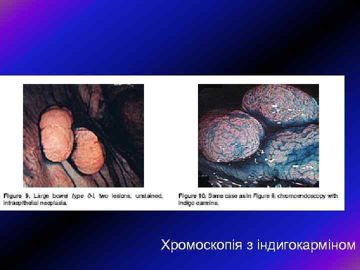 Хромоскопія з індигокарміном 