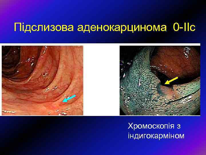 Підслизова аденокарцинома 0 -ІІс Хромоскопія з індигокарміном 