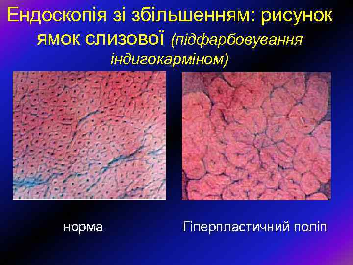 Ендоскопія зі збільшенням: рисунок ямок слизової (підфарбовування індигокарміном) норма Гіперпластичний поліп 