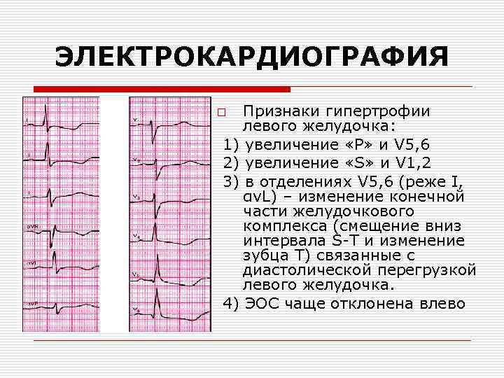 Миокард правого желудочка сердца. Гипертрофия миокарда на ЭКГ. Гипертрофия левого желудочка на ЭКГ. Критерии гипертрофии левого желудочка на ЭКГ. ЭКГ Струтынский гипертрофия левого желудочка.