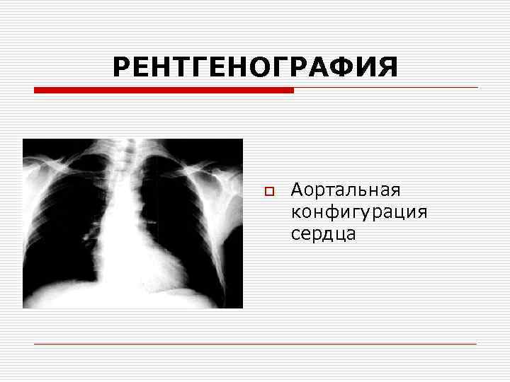 РЕНТГЕНОГРАФИЯ o Аортальная конфигурация сердца 