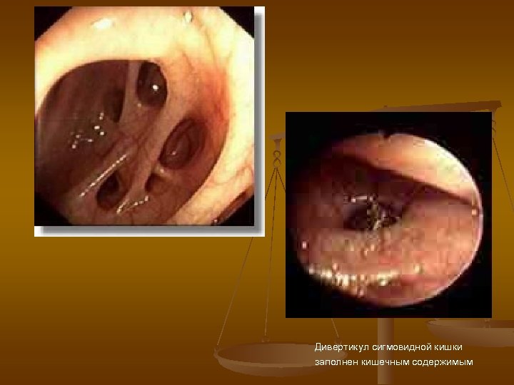 Дивертикул сигмовидной кишки заполнен кишечным содержимым 