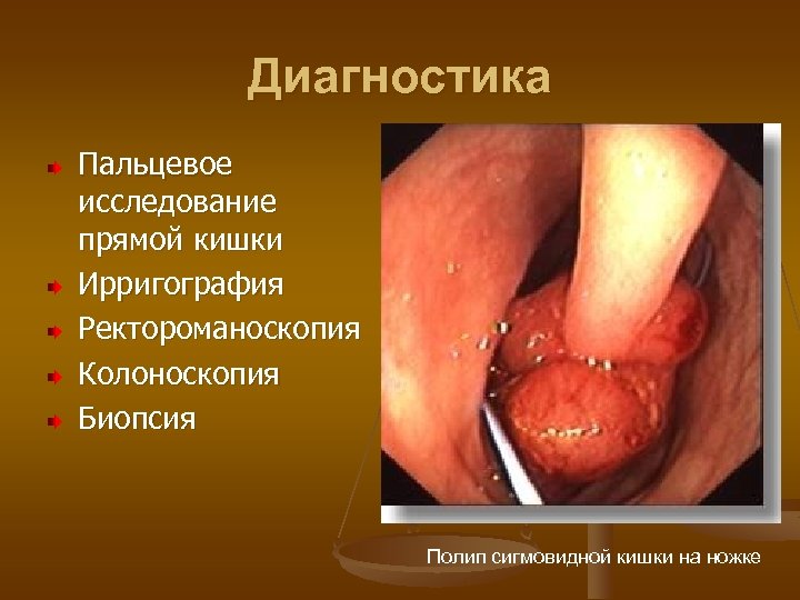 Диагностика Пальцевое исследование прямой кишки Ирригография Ректороманоскопия Колоноскопия Биопсия Полип сигмовидной кишки на ножке