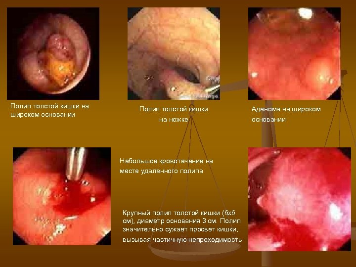 Полип толстой кишки на широком основании Полип толстой кишки на ножке Небольшое кровотечение на