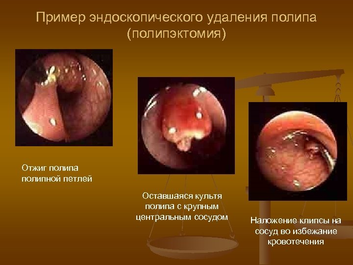 Пример эндоскопического удаления полипа (полипэктомия) Отжиг полипа полипной петлей Оставшаяся культя полипа с крупным
