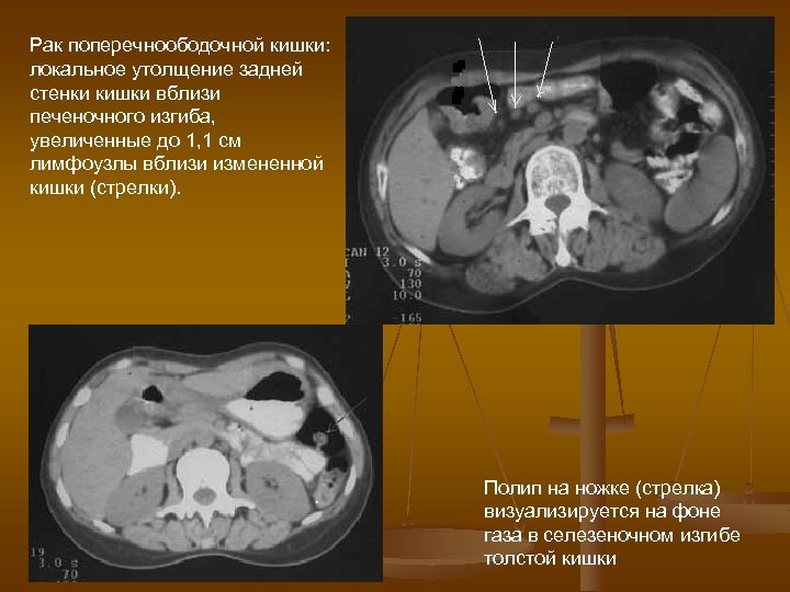Рак поперечноободочной кишки: локальное утолщение задней стенки кишки вблизи печеночного изгиба, увеличенные до 1,