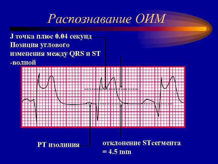 Распознавание ОИМ J точка плюс 0. 04 секунд Позиция углового изменения между QRS и