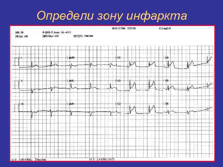 Определи зону инфаркта 