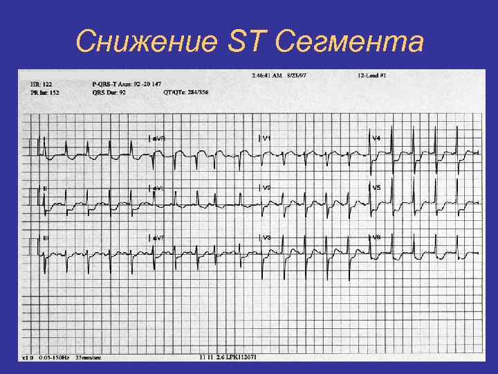 Снижение ST Сегмента 