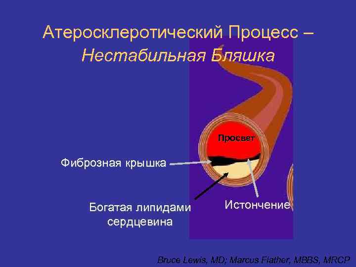 Атеросклеротический Процесс – Нестабильная Бляшка Просвет Фиброзная крышка Богатая липидами сердцевина Истончение Bruce Lewis,