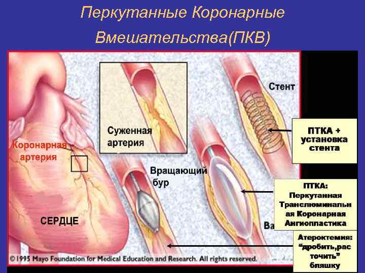 Перкутанные Коронарные Вмешательства(ПКВ) 