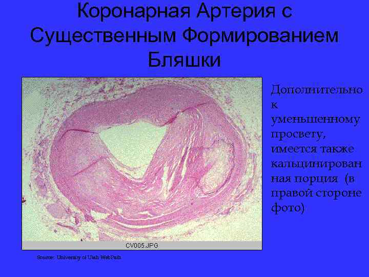 Коронарная Артерия с Существенным Формированием Бляшки Дополнительно к уменьшенному просвету, имеется также кальцинирован ная