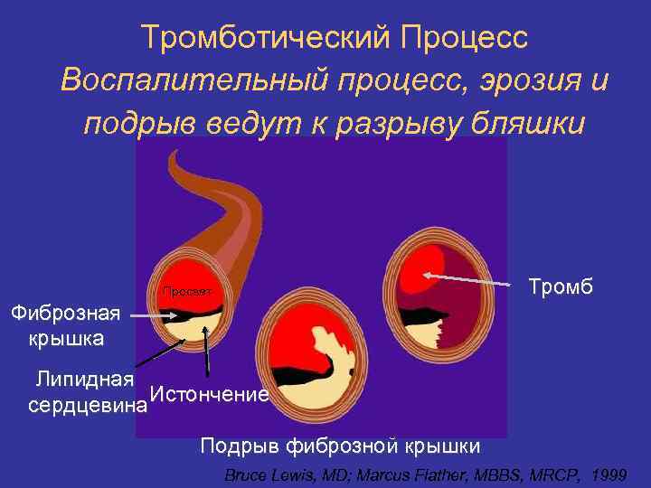 Тромботический Процесс Воспалительный процесс, эрозия и подрыв ведут к разрыву бляшки Тромб Просвет Фиброзная