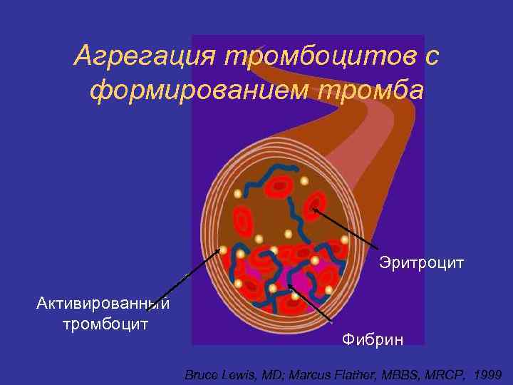 Агрегация тромбоцитов с формированием тромба Эритроцит Активированный тромбоцит Фибрин Bruce Lewis, MD; Marcus Flather,