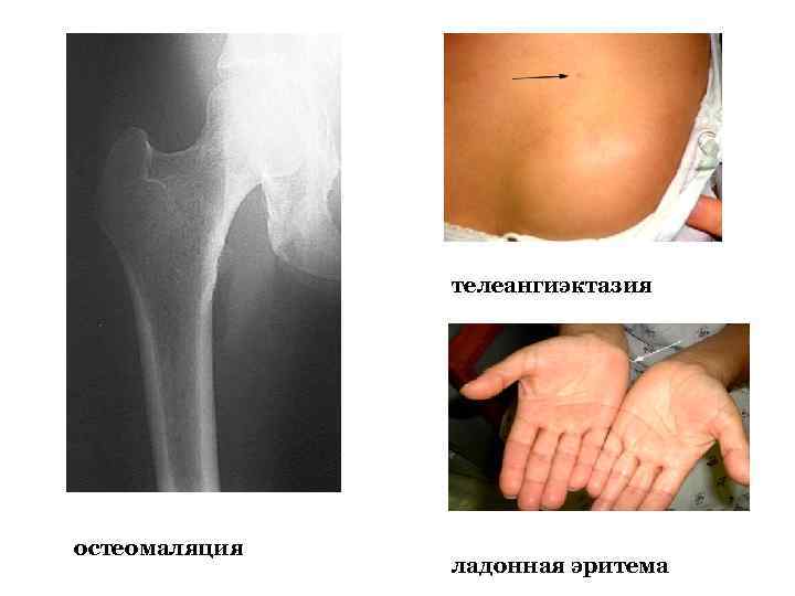 телеангиэктазия остеомаляция ладонная эритема 