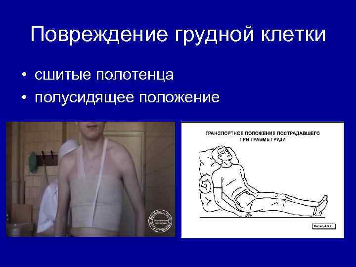 Презентация повреждения грудной клетки