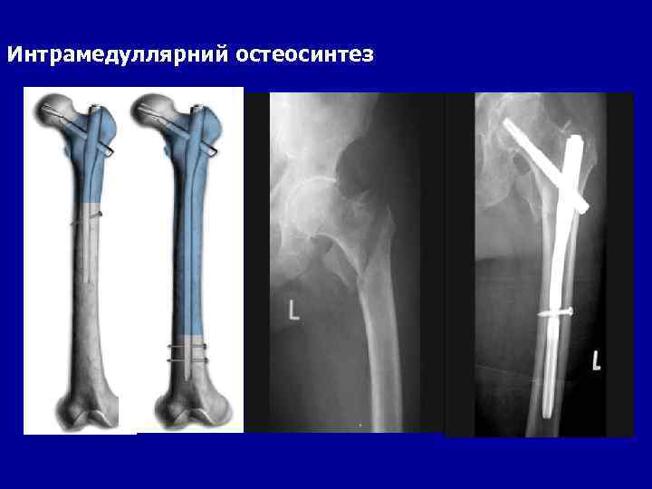 Интрамедуллярний остеосинтез 