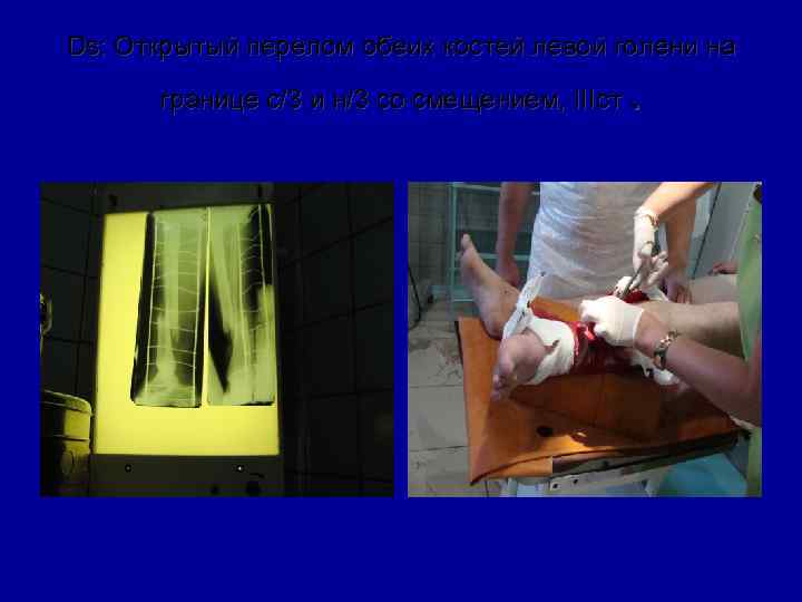 Ds: Открытый перелом обеих костей левой голени на границе с/3 и н/3 со смещением,