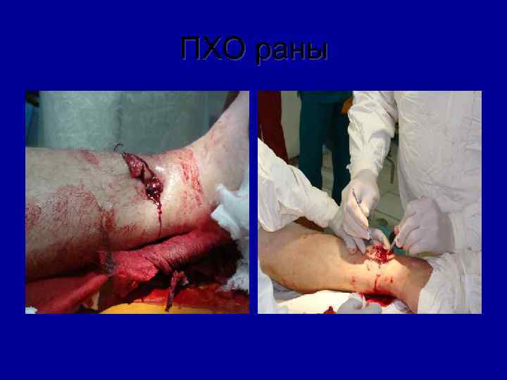 ПХО раны 