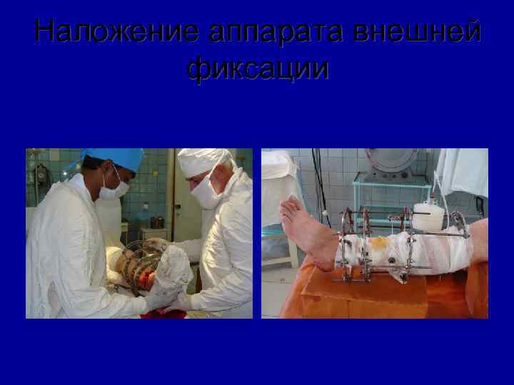 Наложение аппарата внешней фиксации 